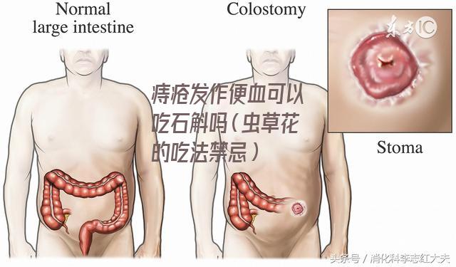 痔疮发作便血可以吃石斛吗